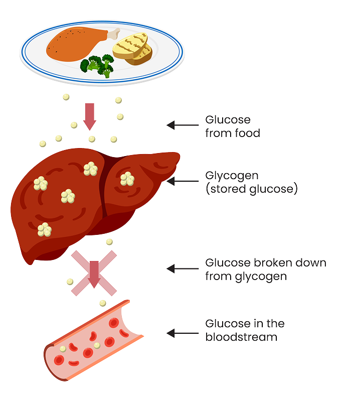 Image showing the typical metabolic process the body takes to turn glycogen into glucose and what the process looks like with GSDIa