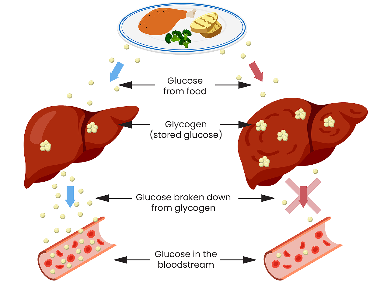 Image showing the typical metabolic process the body takes to turn glycogen into glucose and what the process looks like with GSDIa